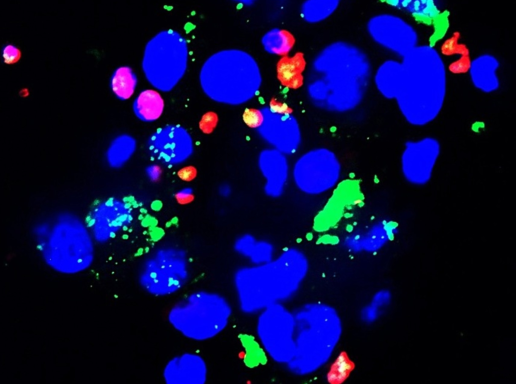  Nanosensors reported T cells (red) killing cancer cells (DAPI blue) in action. Nanosensors self-activated when in contact with cytotoxic proteins released from the T cells, lighting up green signal. Anh Nguyen, Chemical Engineering Department
